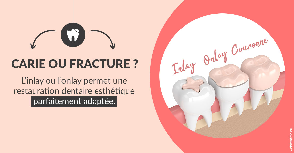 https://dr-bruno-lasfargue.chirurgiens-dentistes.fr/T2 2023 - Carie ou fracture 2