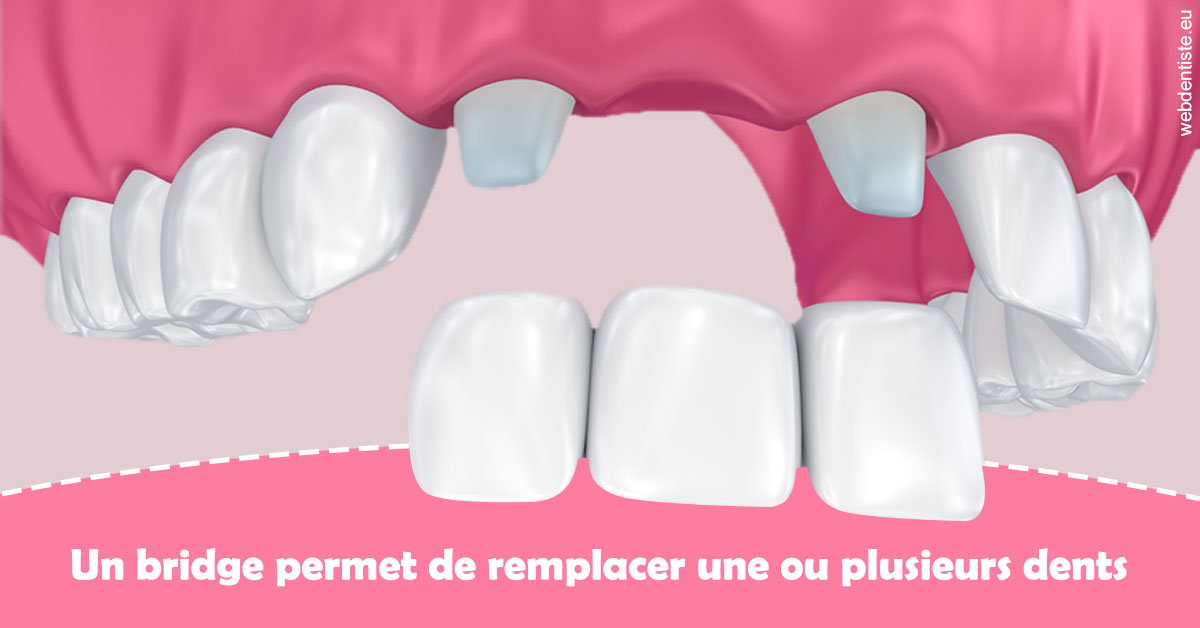 https://dr-bruno-lasfargue.chirurgiens-dentistes.fr/Bridge remplacer dents 2