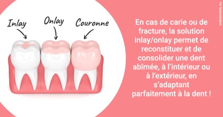 https://dr-bruno-lasfargue.chirurgiens-dentistes.fr/L'INLAY ou l'ONLAY 2