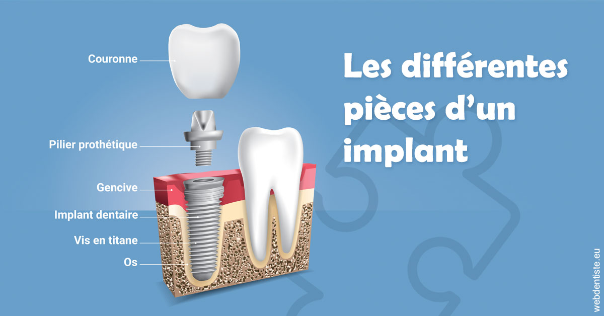 https://dr-bruno-lasfargue.chirurgiens-dentistes.fr/Les différentes pièces d’un implant 1